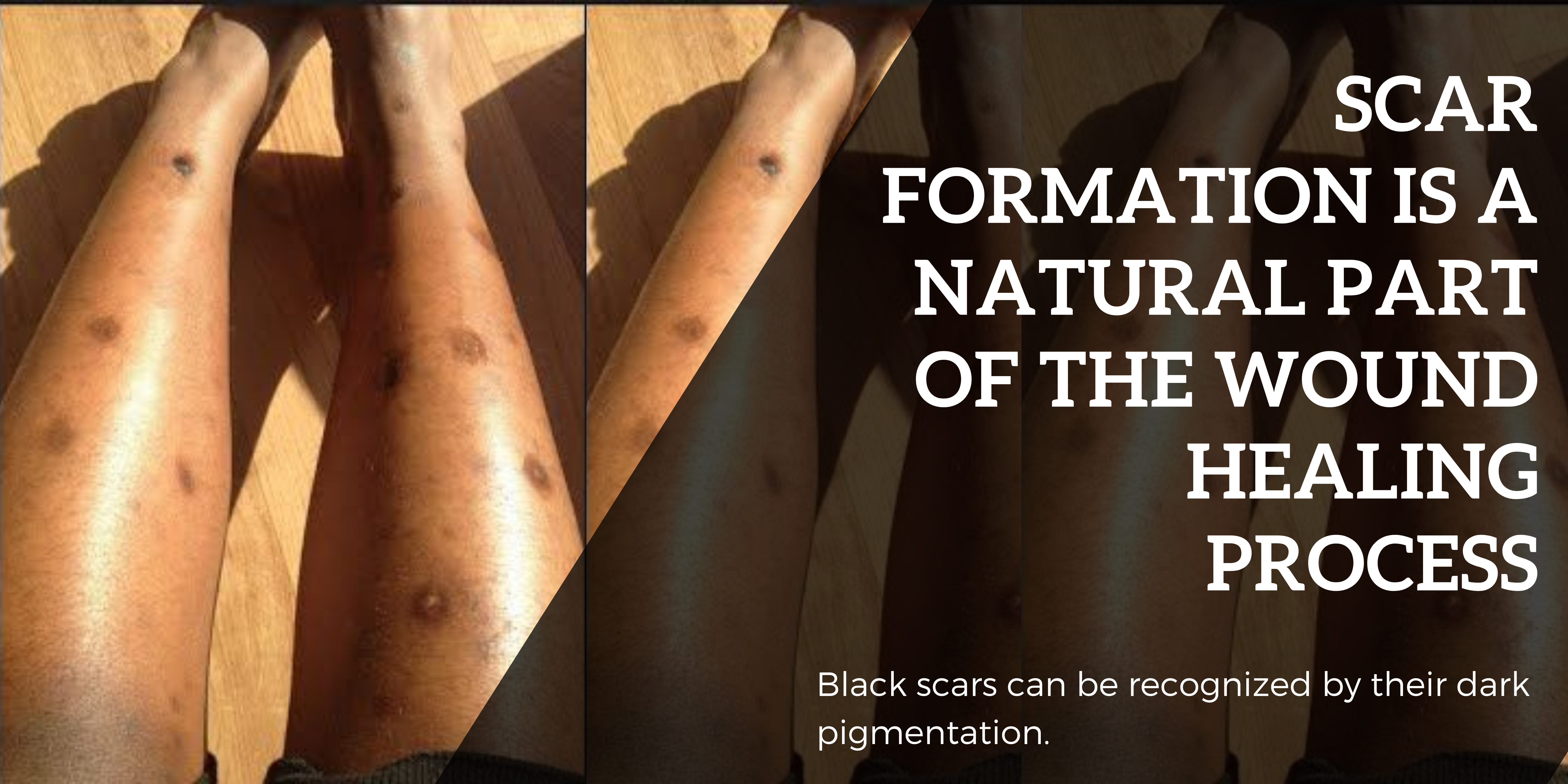 Scar formation is a natural part of the wound healing process