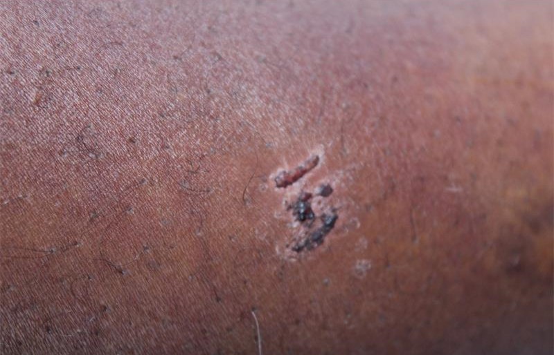 heal 2 how to get rid of dark spots