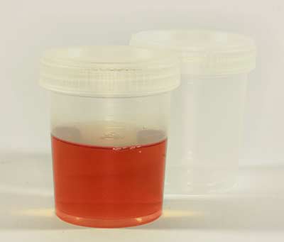 Seeing Red? What Blood in Your Urine or Sperm Could Mean – And What to Do!